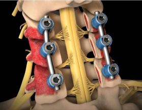 gallery/laminectomy&fusion1