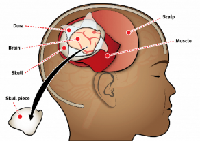 gallery/craniotomy-illustration (1)